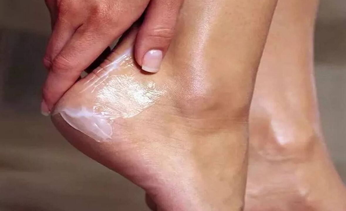 Como tratar o fungo dos pés com creme de fungo