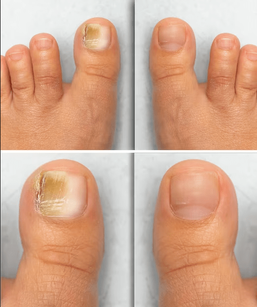 Fungo dos pés - antes e depois do tratamento com creme divertido