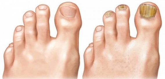 Unhas normais e infectadas
