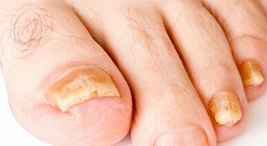 Como tratar o fungo das unhas