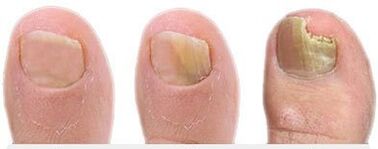 Estágios do desenvolvimento de fungos nas unhas