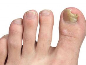 manchas amarelas nas unhas dos sinais de pé do fungo