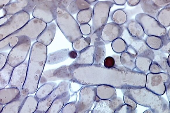células de fungos nas unhas sob um microscópio