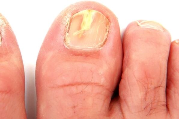 danos à lâmina ungueal devido a uma infecção fúngica