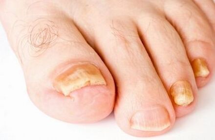 amarelecimento das unhas dos pés devido a fungos