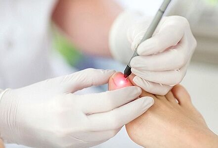 tratamento a laser para fungos nas unhas
