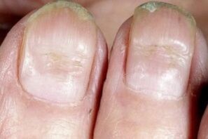 sintomas de fungos nas unhas
