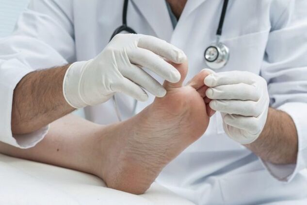 diagnóstico de fungo nos pés por um médico