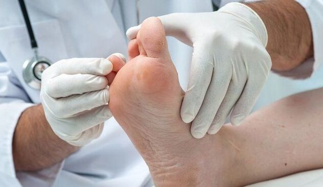 tratamento e diagnóstico de fungos por um médico