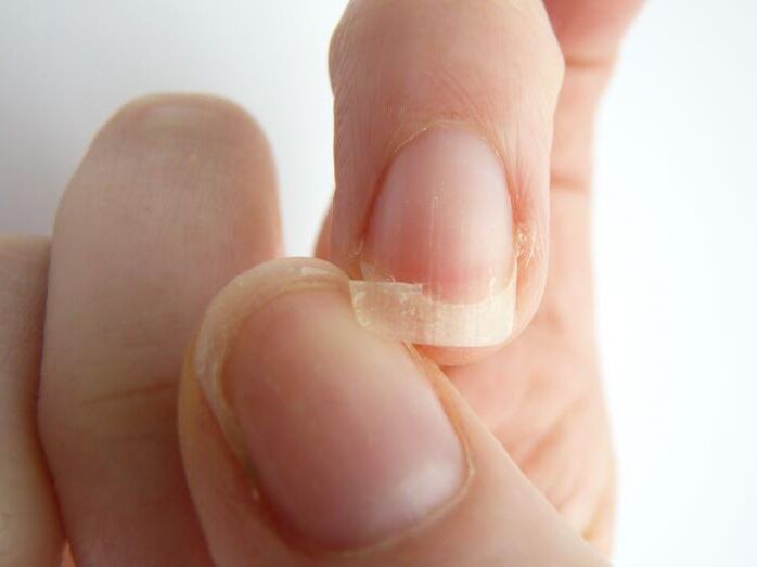 descolamento de unhas devido a fungos