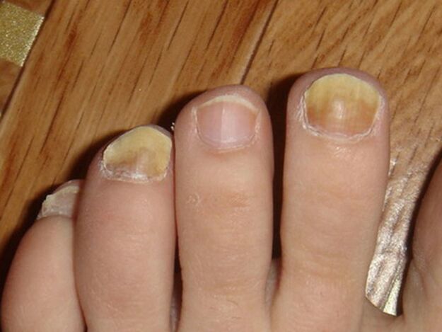 sintomas de fungos nas unhas dos pés