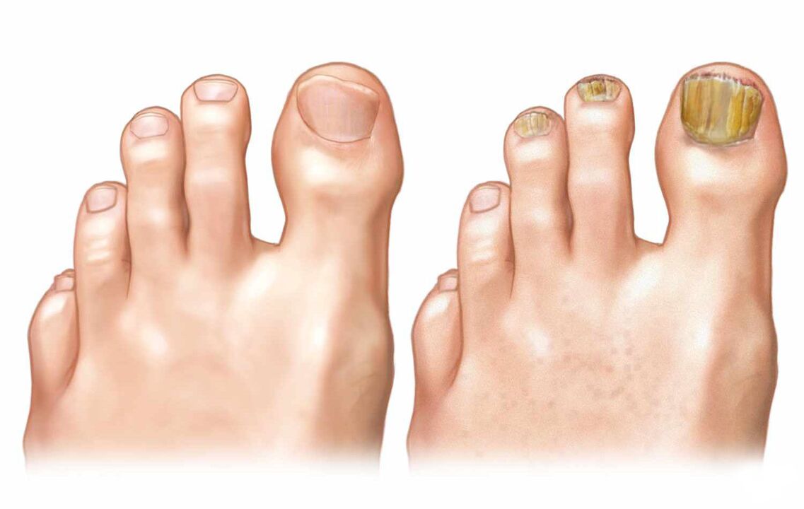 unhas saudáveis ​​e fungos nas unhas