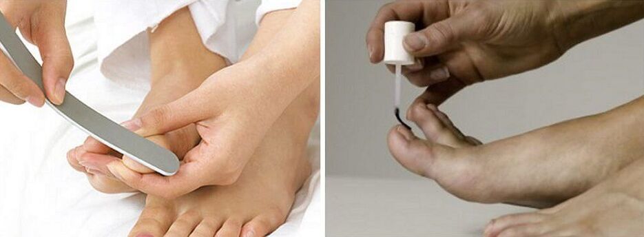 tratamento de fungos nas unhas dos pés com verniz